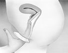 Diagram of female condom insertion